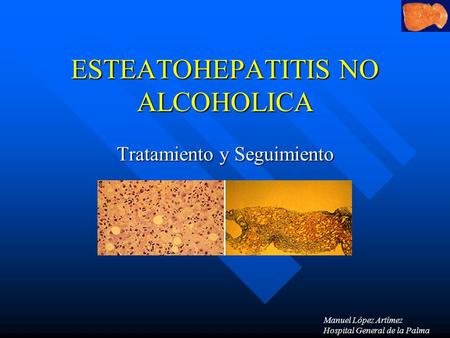 ESTEATOHEPATITIS NO ALCOHOLICA