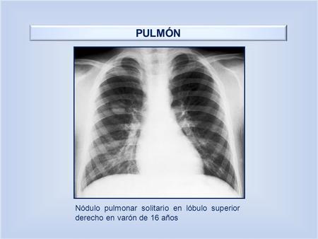 PULMÓN Nódulo pulmonar solitario en lóbulo superior derecho en varón de 16 años.