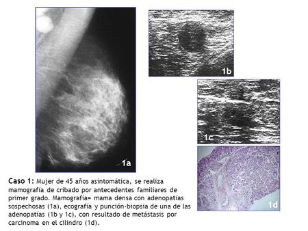 1b 1c 1a Caso 1: Mujer de 45 años asintomática, se realiza mamografía de cribado por antecedentes familiares de primer grado. Mamografía= mama densa con.