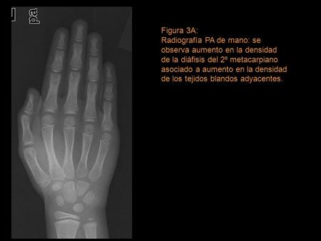 Figura 3A: Radiografía PA de mano: se observa aumento en la densidad de la diáfisis del 2º metacarpiano asociado a aumento en la densidad de los tejidos.