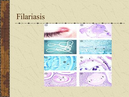 Filariasis.