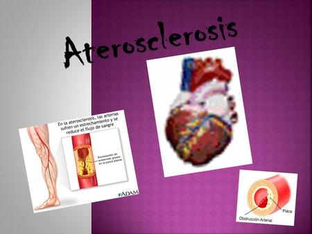 Aterosclerosis.