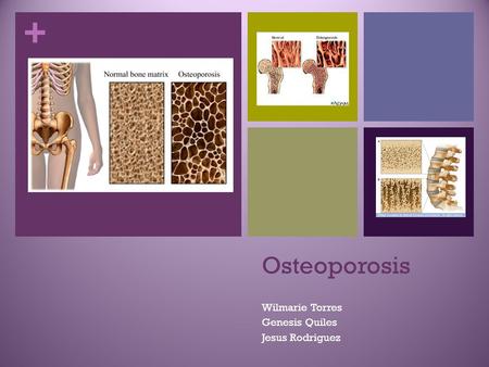 + Osteoporosis Wilmarie Torres Genesis Quiles Jesus Rodriguez.