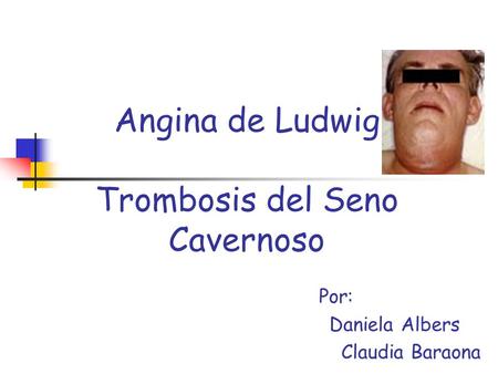 Angina de Ludwig Trombosis del Seno Cavernoso