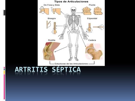 Artritis séptica.