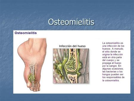Osteomielitis.