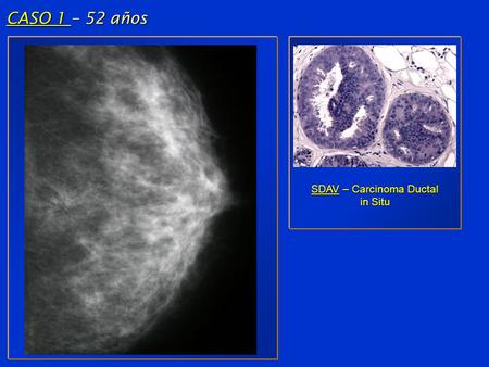 CASO 1 – 52 años SDAV – Carcinoma Ductal in Situ.