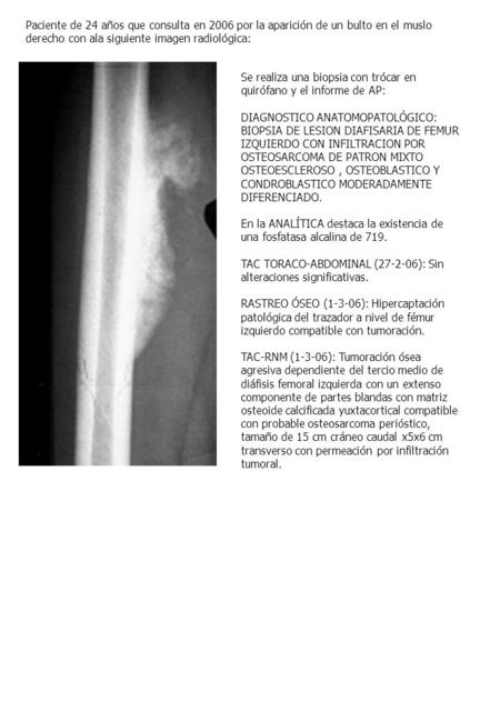 Paciente de 24 años que consulta en 2006 por la aparición de un bulto en el muslo derecho con ala siguiente imagen radiológica: Se realiza una biopsia.