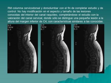RM columna cervicodorsal y dorsolumbar con el fin de completar estudio y de control: No hay modificación en el aspecto y tamaño de las lesiones conocidas.
