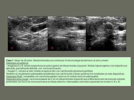 A B C Caso 1. Mujer de 36 años. Nódulos tiroideos en control por Endocrinología desde hace un año y medio. Hallazgos ecográficos: - Imágenes A y B: lesión.
