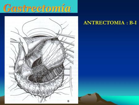 Gastrectomía ANTRECTOMIA : B-I.