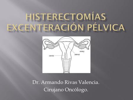 Histerectomías Excenteración pélvica