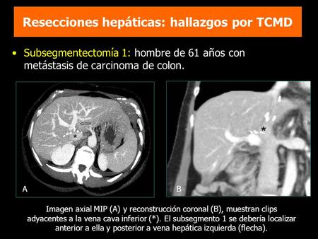 Resecciones hepáticas: hallazgos por TCMD