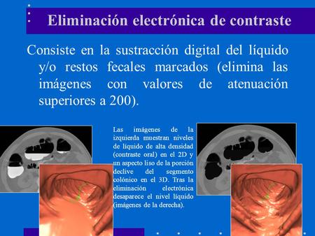 Eliminación electrónica de contraste Consiste en la sustracción digital del líquido y/o restos fecales marcados (elimina las imágenes con valores de atenuación.