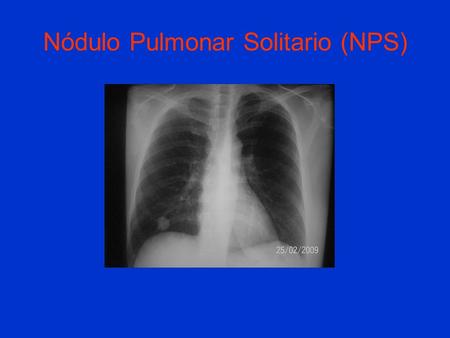 Nódulo Pulmonar Solitario (NPS)