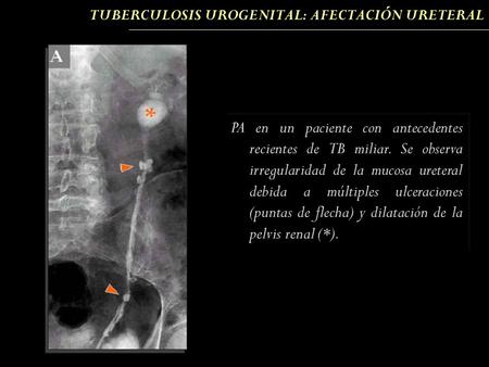 TUBERCULOSIS UROGENITAL: AFECTACIÓN URETERAL