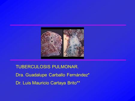 TUBERCULOSIS PULMONAR. Dra. Guadalupe Carballo Fernández*