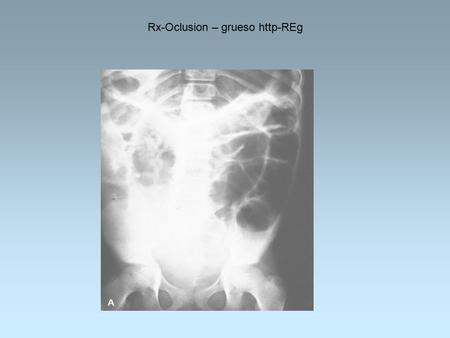 Rx-Oclusion – grueso http-REg