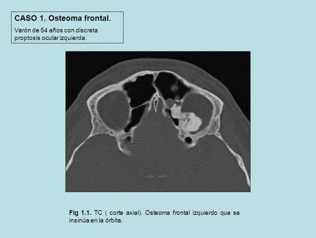 CASO 1. Osteoma frontal. Varón de 54 años con discreta proptosis ocular izquierda. Fig 1.1. TC ( corte axial). Osteoma frontal izquierdo que se insinúa.