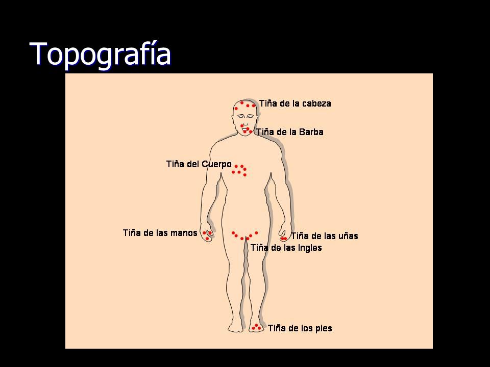 Como curan el hongo en el pie en kitae