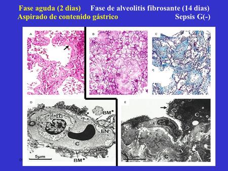 Fase aguda (2 dias) Fase de alveolitis fibrosante (14 dias) Aspirado de contenido gástrico Sepsis G(-) 09/2002 HEBR.