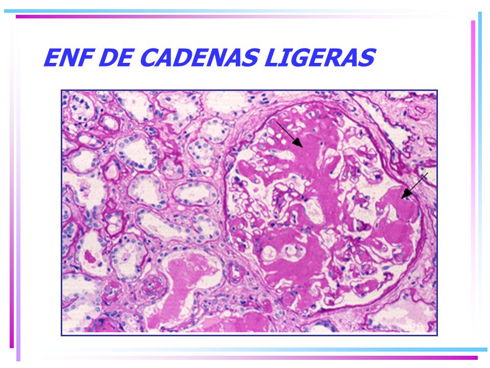 cadenas ligeras e insuficiencia renal nefropatia diabetica causa m 225 s frecuente de irc en usa cadenas ligeras e insuficiencia renal nefropatia diabetica causa m 225 s frecuente de irc en usa
