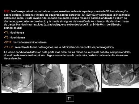RM: lesión expansiva tumoral del sacro que se extiende desde la parte posterior de S1 hasta la región sacro-coxígea. Erosiona y invade los agujeros sacros.