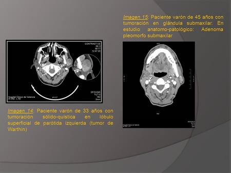 Imagen 15: Paciente varón de 45 años con tumoración en glándula submaxilar. En estudio anatomo-patológico: Adenoma pleomorfo submaxilar Imagen 14: Paciente.