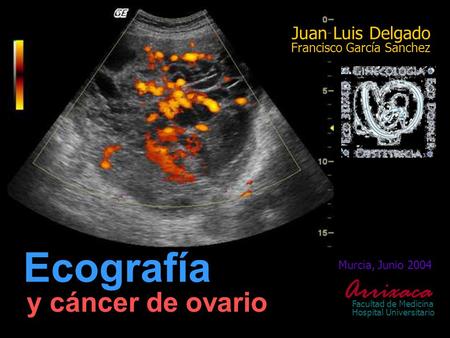 Murcia, Junio 2004 Arrixaca Facultad de Medicina Hospital Universitario y cáncer de ovario Ecografía Juan Luis Delgado Francisco García Sanchez.