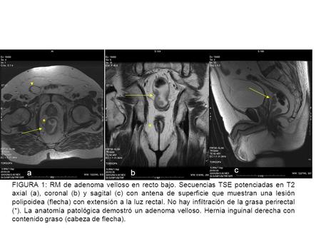 spin-echo T2-weighted MR image obtained with a