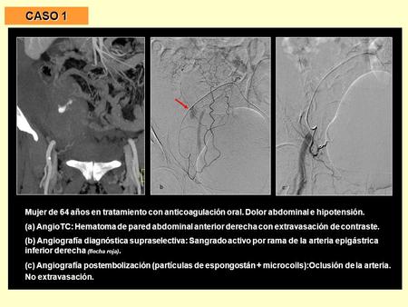 CASO 1 Mujer de 64 años en tratamiento con anticoagulación oral. Dolor abdominal e hipotensión. (a) AngioTC: Hematoma de pared abdominal anterior derecha.