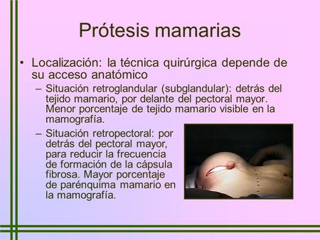 Prótesis mamarias Localización: la técnica quirúrgica depende de su acceso anatómico Situación retroglandular (subglandular): detrás del tejido mamario,