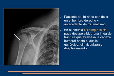 Paciente de 49 años con dolor en el hombro derecho y antecedente de traumatismo. En el estudio Rx simple inicial pasa desapercibida una línea de fractura.