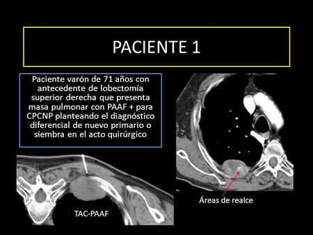 PACIENTE 1 Paciente varón de 71 años con antecedente de lobectomía superior derecha que presenta masa pulmonar con PAAF + para CPCNP planteando el diagnóstico.