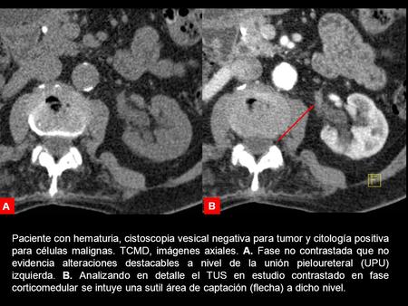 A B Paciente con hematuria, cistoscopia vesical negativa para tumor y citología positiva para células malignas. TCMD, imágenes axiales. A. Fase no contrastada.