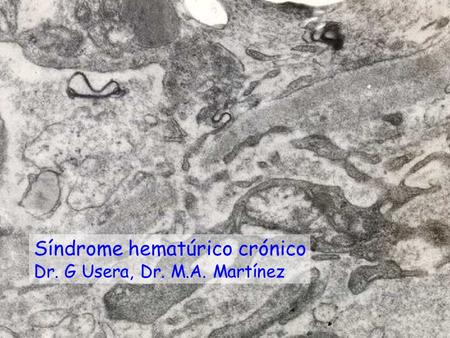 Síndrome hematúrico crónico