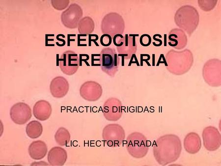 ESFEROCITOSIS HEREDITARIA