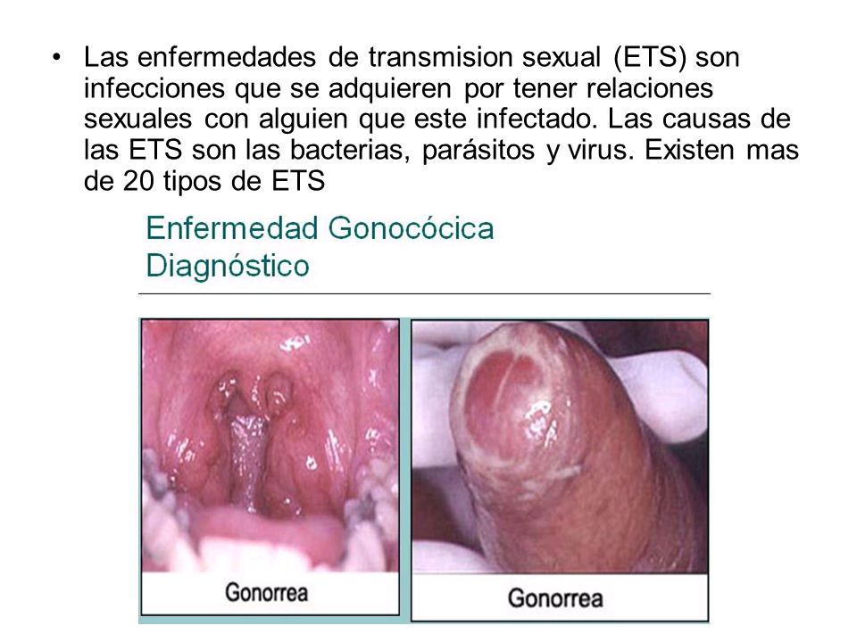 Infecciones Sexsuales 44