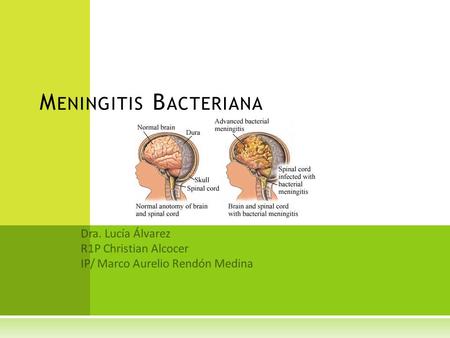 Meningitis Bacteriana