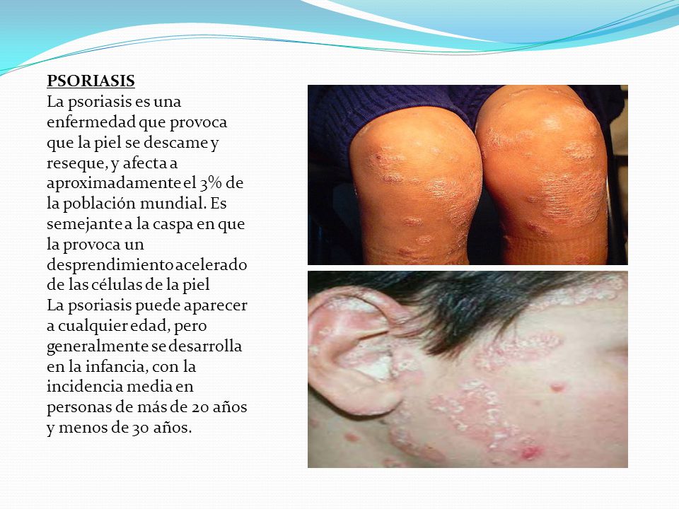 La psoriasis del prepucio de la foto