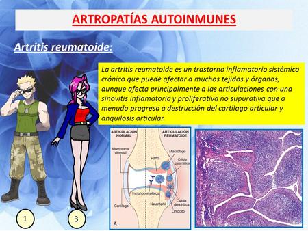 ARTROPATÍAS AUTOINMUNES Artritis reumatoide: La artritis reumatoide es un trastorno inflamatorio sistémico crónico que puede afectar a muchos tejidos y.