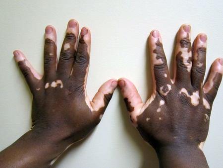 Vitiligo infantil El vitiligo puede aparecer en cualquier punto de la vida de cada personavitiligo Ain así, se estima que hasta un 80% de los casos.