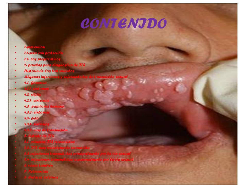 Enfermedades venereas papiloma humano fotos 27 Enfermedades venereas papiloma humano fotos 85