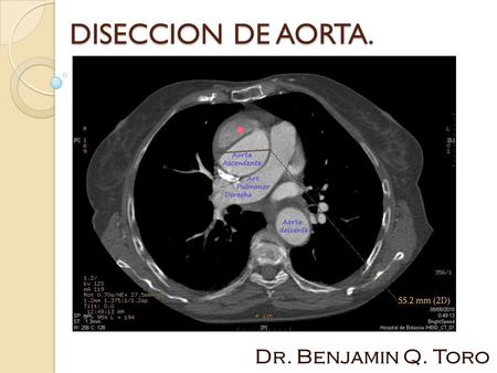 DISECCION DE AORTA. Dr. Benjamin Q. Toro.