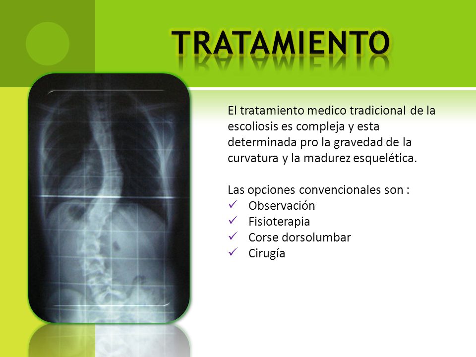 La escoliosis a los niños antes del tratamiento y después de