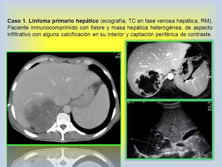 Caso 1. Linfoma primario hepático (ecografía, TC en fase venosa hepática, RM). Paciente inmunocomprimido con fiebre y masa hepática heterogénea, de aspecto.