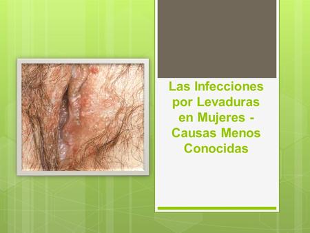 Las Infecciones por Levaduras en Mujeres - Causas Menos Conocidas.