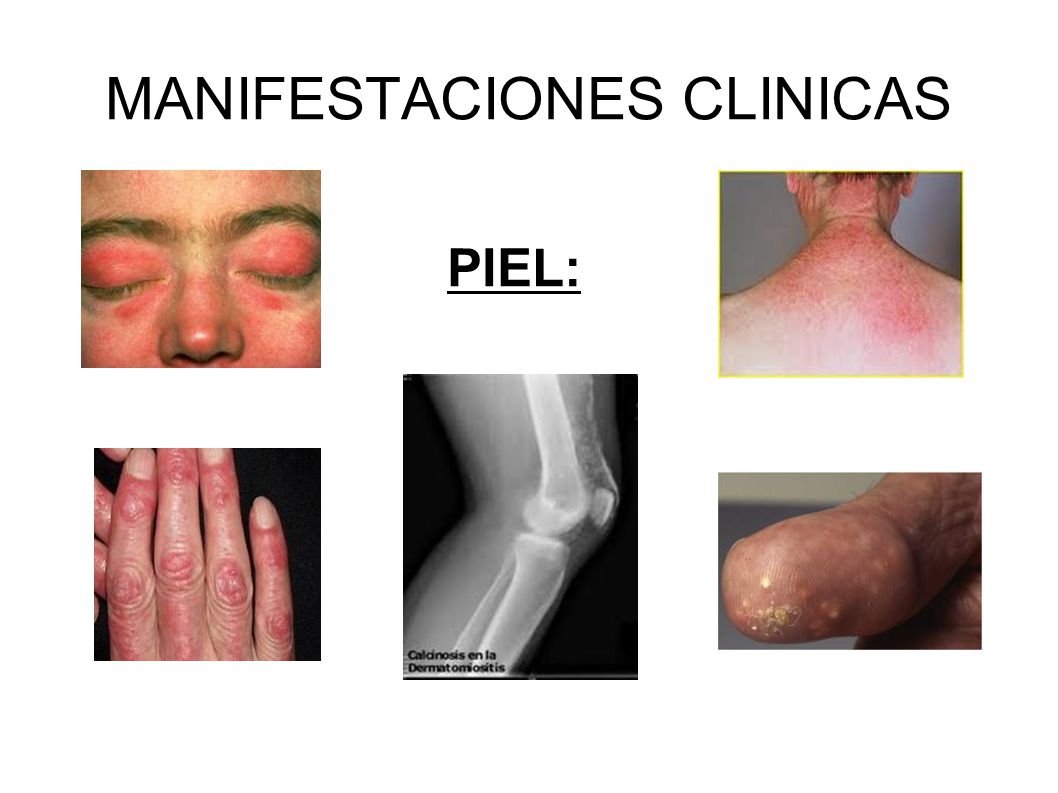 Fotosensibilidad ocular y dolor de cabeza 2 Fotosensibilidad ocular y dolor de cabeza 2