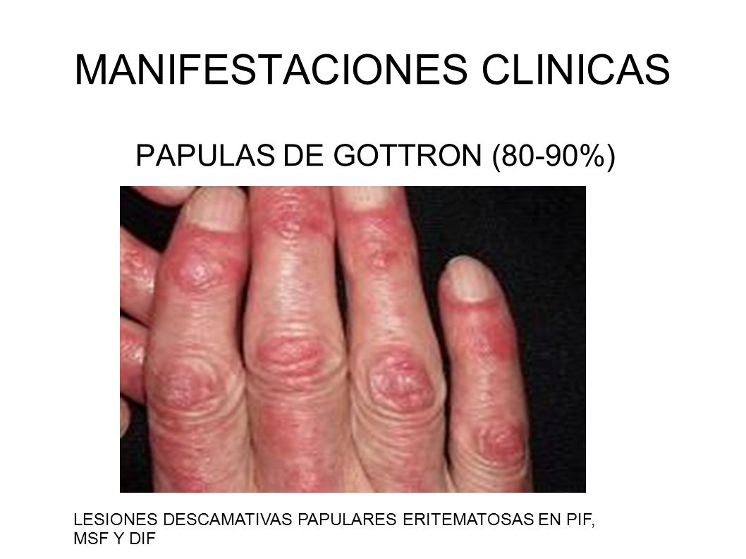 Fotosensibilidad ocular y dolor de cabeza 44 Fotosensibilidad ocular y dolor de cabeza 5