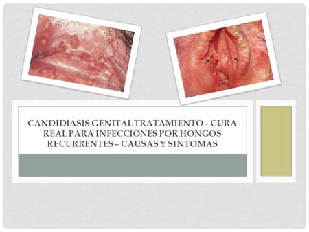 Candidiasis Genital Tratamiento – Cura Real para Infecciones por Hongos Recurrentes – Causas y Sintomas.